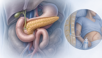 intrathecal morphine versus wound infiltration after pancreatoduodenectomy