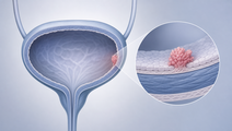 bcg plus mitomycin fails to improve dfs in anzup 1301