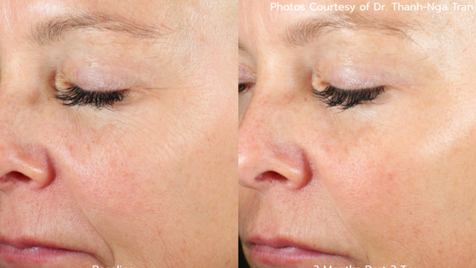 AVAVA FDA approval wrinkles