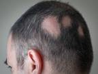 Alopecia
