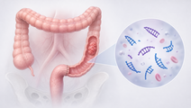 post adjuvant trifluridine tipiracil in ctdna positive colorectal cancer