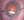 Figure 6. The second paracentesis wound is hydrated before the irrigation handpiece is removed from the eye.