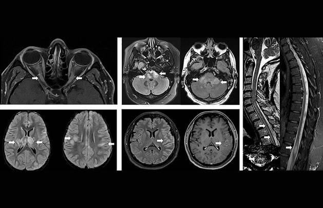MS Minute Myelin Oligodendrocyte Glycoprotein AntibodyAssociated Disease