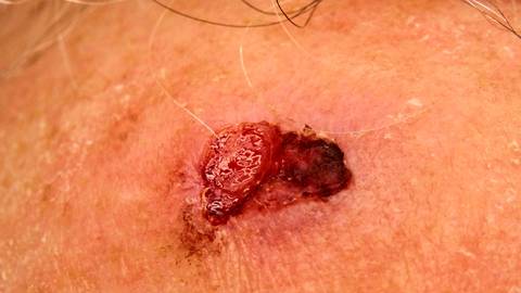 Cutaneous Signet Ring Squamous Cell Carcinoma Case Presentation and Brief Literature Review