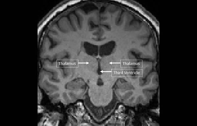 MS Minute Cognitive Dysfunction in People Living with Multiple Sclerosis