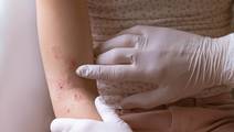 Pediatric Atopic Dermatitis