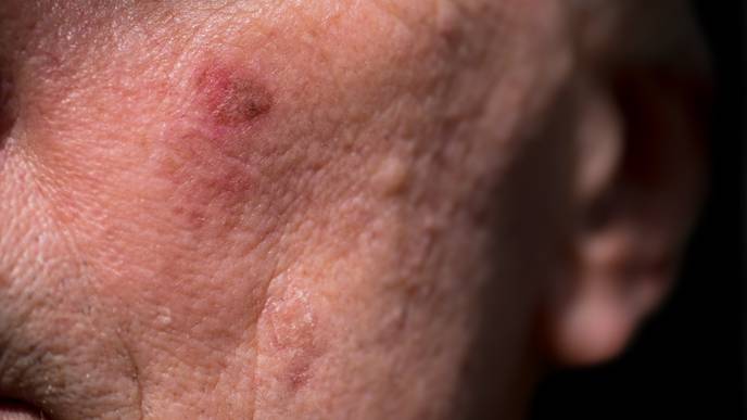 actinic keratosis