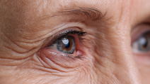 Lower Blepharoplasty