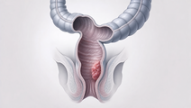 color iii short term outcomes for tatme versus laptme