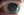 Figure 2. Corneal edema and large, dense keratic precipitates.