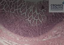 Virtual IBD Clinic: Disease Management and Surgery