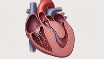 mavacamten in adolescents with obstructive hypertrophic cardiomyopathy