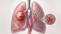 Bulky non small cell lung cancer in the lung with locoregional embolization concept
