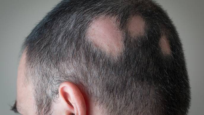 Alopecia