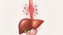 EoE Linked to Higher Long Term NAFLD Cirrhosis Risk