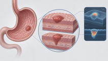 Simplified stomach illustrating AI assessment of mucosal versus submucosal early gastric cancer