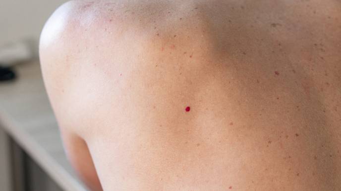 cherry angioma
