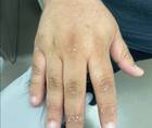 Verrucous psoriasis
