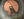 Figure 7. An IOL with a slim haptic-optic junction is injected, and the leading loop is directed into the prepared capsular pocket.