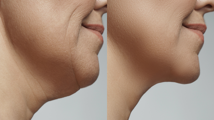facial weight loss