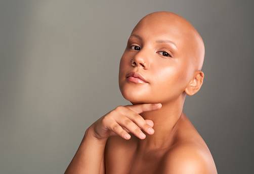 Alopecia areata