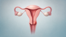 Simplified uterus and cervix showing a localized early stage cervical cancer lesion