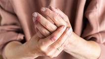 atopic dermatitis