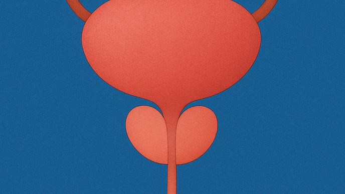 Genetic Test Predicts Radiation Toxicity in Prostate Cancer