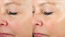 AVAVA FDA approval wrinkles