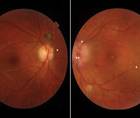 Cytomegalovirus and Herpes Simplex Virus Coinfection Neuroretinitis in an Immunocompetent Individual