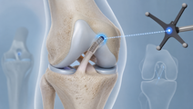 Knee joint illustration showing ACL reconstruction navigation with a 3D bone overlay