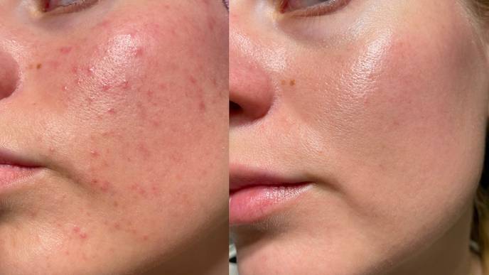 facial rejuvenation