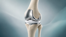 Simplified knee joint with arthroplasty implant illustrating the setting for anesthesia resource comparisons