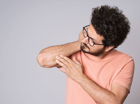 Psoriasis