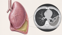 phase 2a trial of intrapleural lti 01 in pleural infection