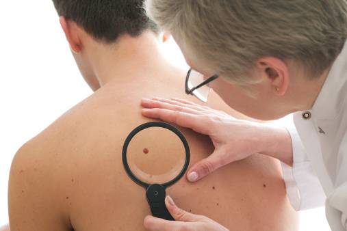 skin cancer