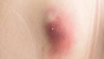 hidradenitis suppurativa
