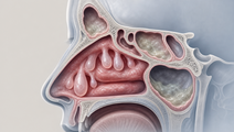 tezepelumab reduced polyp burden in severe crswnp trial