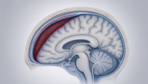 nbutyl cyanoacrylate embolization for chronic subdural hematoma
