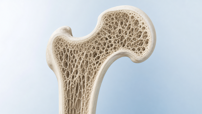 Illustrated porous bone cross section representing osteoporotic fracture vulnerability assessed in patients with gout