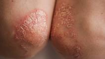 plaque psoriasis