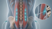 Continuous Bilateral Erector Spinae Plane Block in Lumbar Spine Surgery