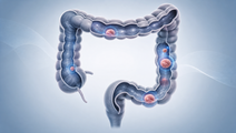 ai assisted colorectal lesion detection falls short in private practice trial
