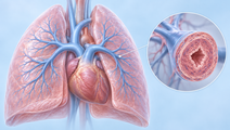 Once Daily Oral Ralinepag Lowers Clinical Worsening Risk in Pretreated PAH