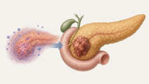 pancreatic ductal adenocarcinoma with autoimmune pancreatitis