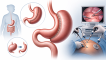Clinical Obesity Common in Bariatric Surgery Candidates