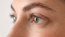 Brow Lift
