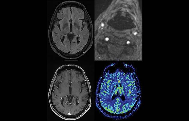 Critical Bilateral Carotid Artery Disease Presenting as Hemichorea