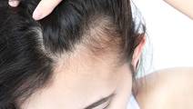 Hair Loss Treatment