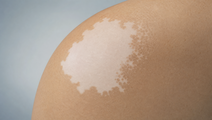 Illustrated skin with a vitiligo patch and subtle repigmentation along the depigmented area edge